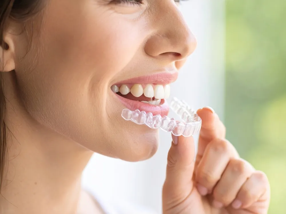 Gouttières Invisalign® — Dre Dalassou certifiée Orthodent Gouttières Invisalign® transparentes — orthodontie invisible amovible adulte Suisse romande